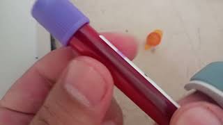 HBA1C test procedure how read HBA1C test through ichroma special biochemistry analyzer HBA1C test [upl. by Woll418]