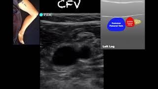 POCUS  Lower Extremity Deep Venous Thrombosis DVT  Updated [upl. by Thedric511]