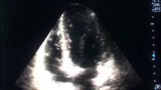 Myocarditis and echocardiographydrahmadmirdamadisiRSay4FU8O1HxWfD9 [upl. by Huppert996]