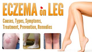 Eczema on Legs Causes Pictures Types Symptoms Treatment Prevention and Natural Home Remedies [upl. by Ssur]