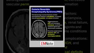 Posterior Reversible Encephalopathy Syndrome PRES doctor medical nursing [upl. by Chantalle602]