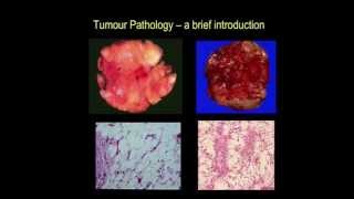 Tumour pathology  a brief introduction part III [upl. by Mailliwnhoj]