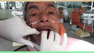 HOW TO RECORD JAW RELATIONS IN COMPLETE DENTURE PATIENT [upl. by Renelle702]