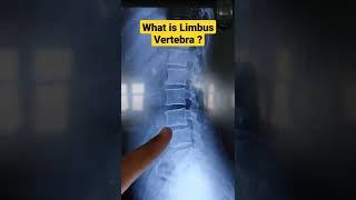 What is Limbus Vertebra Dr Sai Chandra MBBS DNB Ortho [upl. by Tannen]