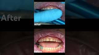 Full Mouth Restoration  Teeth Attrition Treatment shorts dentist [upl. by Zelikow]