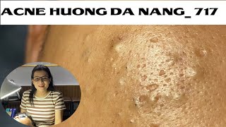 Acne Treatment Huong Da Nang 717  Remove Blackheads [upl. by Durkin]