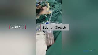 Percutaneous Nephrostomy Sheath Suction Sheath [upl. by Arrahs723]