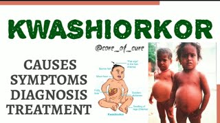 KWASHIORKOR  CAUSES  SYMPTOMS  DIAGNOSIS  TREATMENT [upl. by Chap]