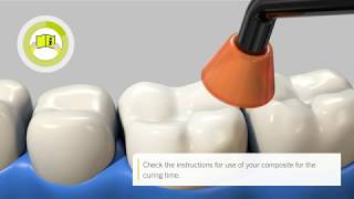 Stepbystep intraoral repair of zirconiabased restorations with iBOND Universal EN [upl. by Clova]