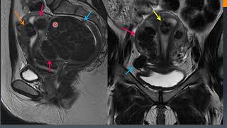 Diagnostico por imágenes Patología miometrial y endometrial [upl. by Arual147]