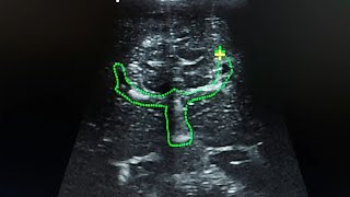 cranial ultrasound  agenesis of the corpus callosum [upl. by Natfa]