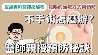 【皮膚專科醫師來解答】雞眼如何根除與預防有哪些治療方式皮膚專科醫師親授超簡單預防雞眼疼痛的方法 [upl. by Ujawernalo279]