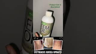 How To Cure Pityriasis Rosea😲 pityriasisroseatreatment pityriasisrosea neemoil [upl. by Fregger]