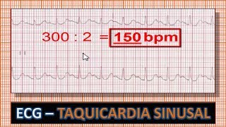 ECG  Eletrocardiograma com Taquicardia Sinusal [upl. by Seeto]