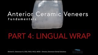 Anterior Ceramic Veneers Part 4 Lingual Wrap [upl. by Ahsel786]