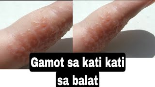 Paano ko nagamot ang Dyshidrotic Eczema o kati kati sa balat [upl. by Sucam761]