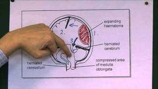 Head Injuries 9 Tentorial herniation [upl. by Lertram436]