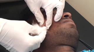 Ellman Radiosurgery Dr Bhutada skin clinic India [upl. by Rafi]