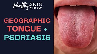 What is Geographic Tongue Is It a Sign of PSORIASIS  Jennifer Fugo [upl. by Urbanus922]