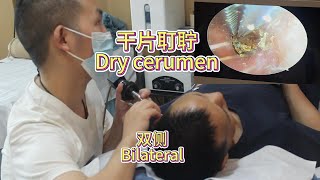 Bilateral Dry cerumen Decompress [upl. by Rola]