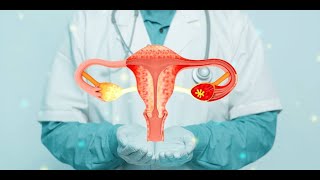 Rectosigmoid Endometriosis A Rare Cause of Haemafacia [upl. by Lazaruk]