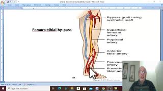 Arterial Disorders in Arabic 28  Buergers Disease  part 2   by Dr Wahdan [upl. by Cosme]