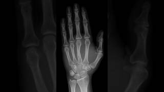 Third metacarpal fracture xrayhand [upl. by Donielle]