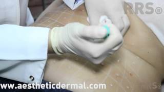 RRS Cellutrix  Video guida trattamento cellulite mesoterapia [upl. by Enair83]