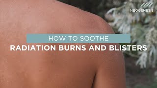 How to Soothe Radiation Burns and Blisters [upl. by Ruiz]