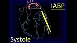 Intraaortic Balloon Pump Aortic Pressure Curve [upl. by Kenlee98]