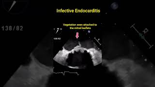 Infective Endocarditis [upl. by Wolfson]