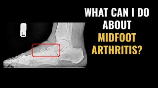 What to do about foot arthritis in the middle of your foot [upl. by Zeni423]