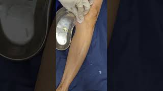 Knee cyst aspiration and injection procedure [upl. by Johnny461]