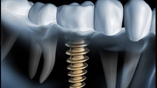 worauf kommt es an bei einem Zahnimplantat [upl. by Nirro]
