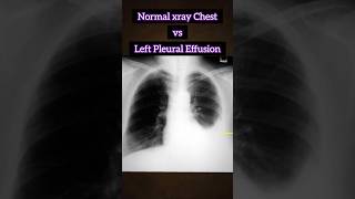 Normal xray vs Pleural Effusion 🩻 🫁 medical xray disease radiology infection shorts [upl. by Klemens]