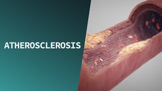 Atherosclerosis  Pathologies [upl. by Ludwog245]