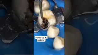 LO ENGAÑOSO DE LA CARIES DENTAL shorts youtubeshorts dentista viral [upl. by Raffaj]