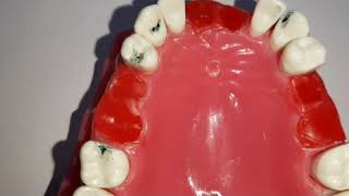 Rest and Rest seat in Removable partial dentures [upl. by Koser85]