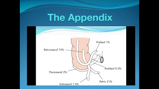 Acute Appendicitis [upl. by Esiuole640]