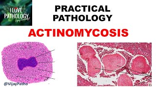 Practical Pathology ACTINOMYCOSIS [upl. by Lehsar]