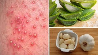 7 Powerful Home Remedies to Get Rid of Folliculitis [upl. by Nylekcaj]