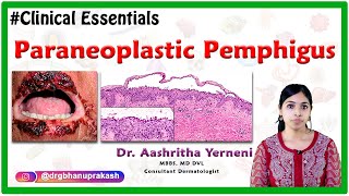 Paraneoplastic pemphigus Clinical essentials Dr Aashritha yerneni [upl. by Dragoon]