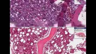 Histopathology Bone marrow  adenocarcinoma metastatic [upl. by Leandre467]