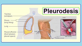 pleurodesis [upl. by Niki918]