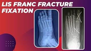 LISFRANC FRACTURE FIXATION IN A YOUNG MALE ASSOCIATED WITH MULTIPLE METATARSAL FRACTURES [upl. by Narrad]