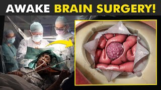 Why Patient Is Awake During This Brain Surgery Awake Craniotomy [upl. by Norwood]