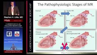 Mitral Regurgitation Stephen H Little MD Sunday August 21 2016 [upl. by Ys]