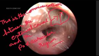 POST AURICULAR SINUS [upl. by Cullen]