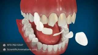 Cosmetic Dentistry Procedures  Dental Animation [upl. by Sokim712]