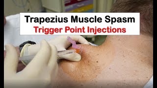 Trapezius Muscle Spasm Trigger Point Injection [upl. by Anirba531]